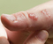 Treating common skin infections in children